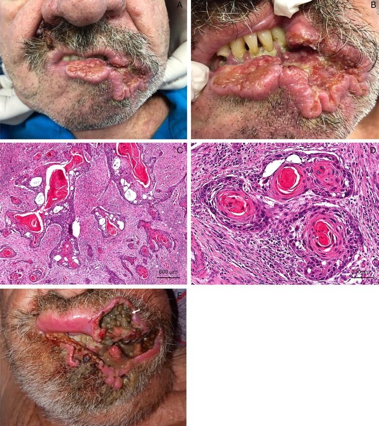 Myiasis infestation in advanced lip squamous cell carcinoma due to COVID-19 pandemic-related treatment delays.
