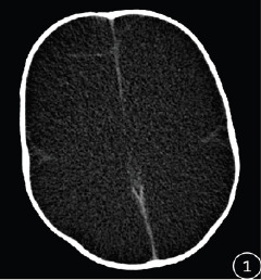 Hydranencephaly: exploring the role of CT features in the diagnosis of 22 cases.