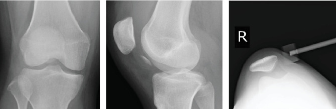 Osteochondral Fracture of the Posterior Aspect of Lateral Femoral Condyle Presumably Caused by Tibia Pushing Up Against the Femur-A Case Report.