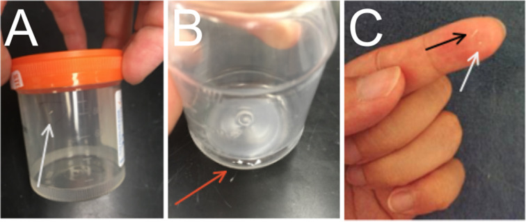 Recurrent Nipple Duct Obstruction in Two Breastfeeding Patients: A Case Report and Discussion of the Underlying Pathophysiology.