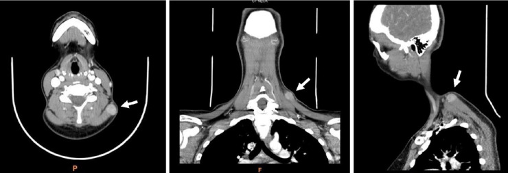 An inflammatory myofibroblastic tumor of the soft tissue of the neck: a case report and literature review.