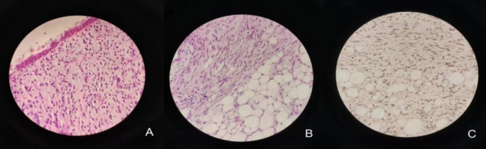 Primary Pulmonary Liposarcoma: A Case Report.