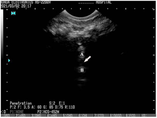 Comparative experimental anesthesia efficacy study of epidural injection at the sacrococcygeal space using ultrasound guidance versus blindness technique in Egyptian donkeys (Equus asinus).