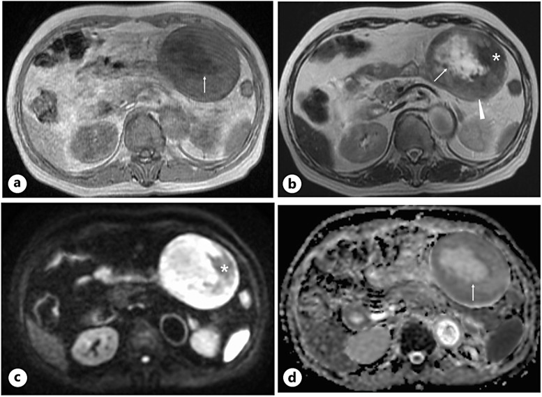 An Intra-Abdominal Desmoid Tumor with Edematous Loose Collagen Fibers.