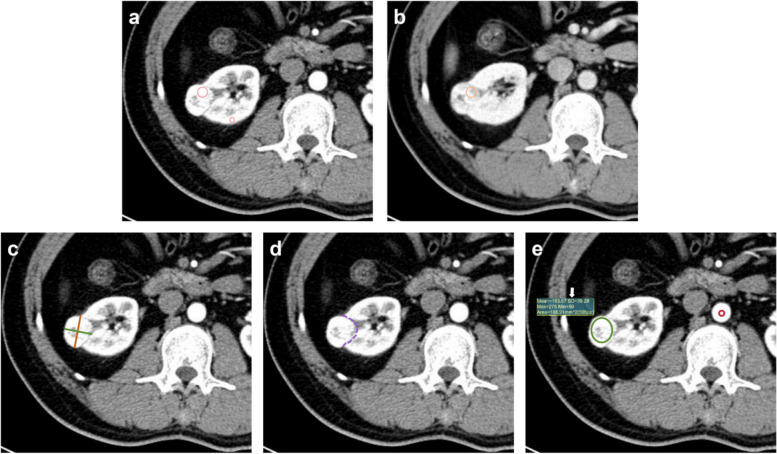 Development of modified multi-parametric CT algorithms for diagnosing clear-cell renal cell carcinoma in small solid renal masses.