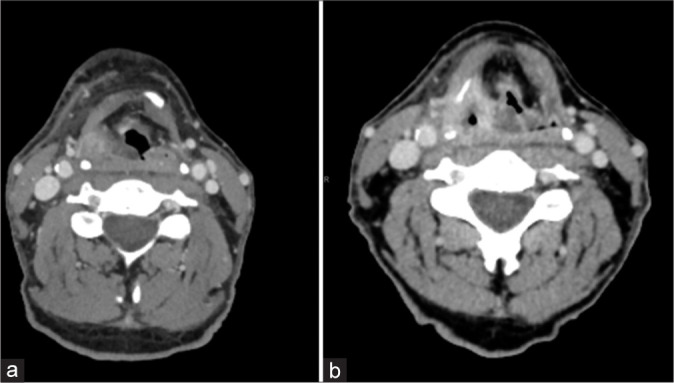 The imaging presentation of head and neck oncologic emergencies.