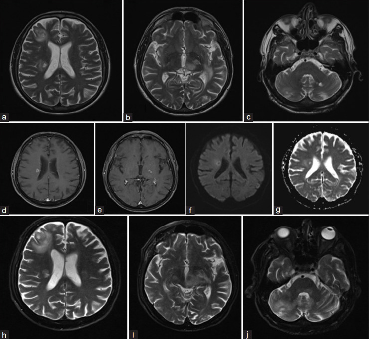 Treatment-resistant inflammatory demyelinating pseudotumor with Marburg-like features: A narrative review-based treatment approach.