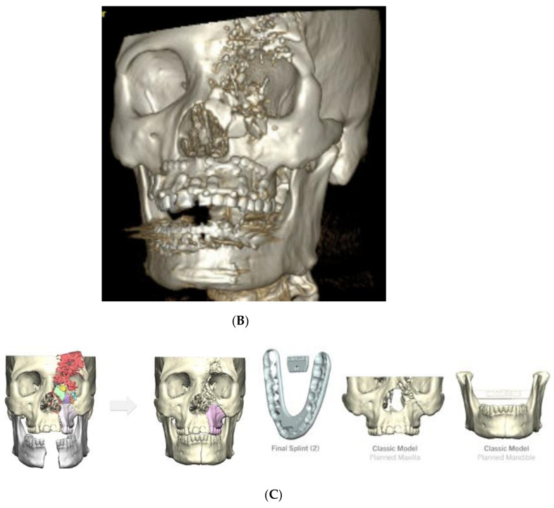 Virtual Surgical Planning for Management of Acute Maxillofacial Trauma.