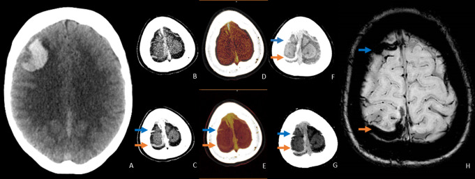 Dual-energy CT angiography in detecting underlying causes of intracerebral hemorrhage: an observational cohort study.