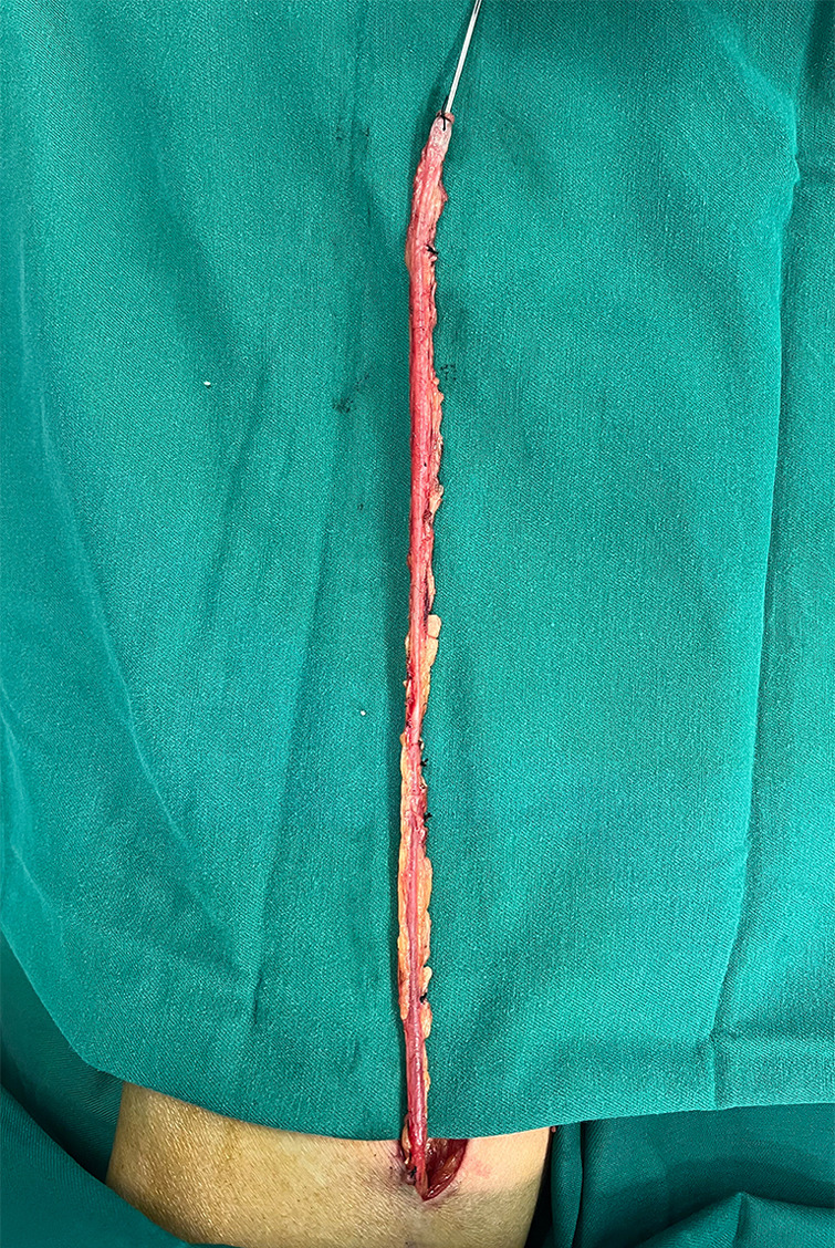 One-year patency rates of saphenous vein grafts harvested using the no-touch technique in off-pump coronary artery bypass grafting.