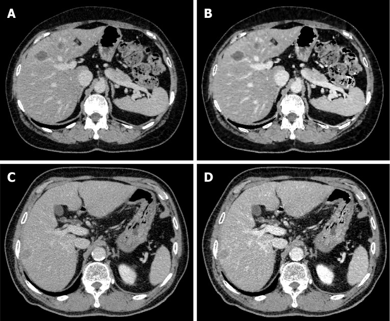 Equilibrium phase images of the liver using a contrast-enhancement boost instead of the portal vein phase.