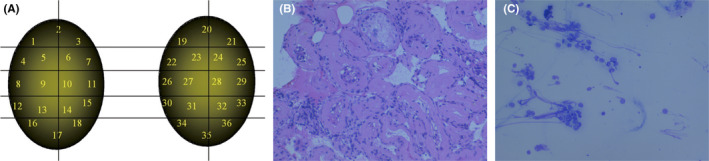 Revisiting non-obstructive azoospermia: Is there a best way to retrieve testicular sperm?