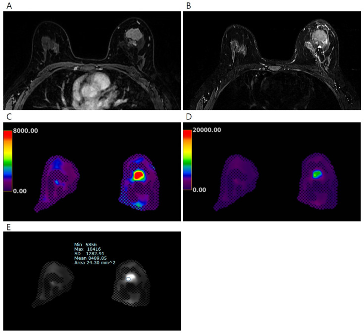 Magnetic Resonance Elastography of Invasive Breast Cancer: Evaluating Prognostic Factors and Treatment Response.