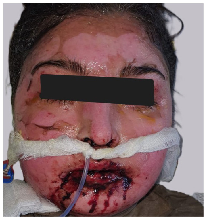 Evaluation of clinical features and treatment modality of pediatric patients with Steven Johnson syndrome/toxic epidermal necrolysis: a single-center experience.