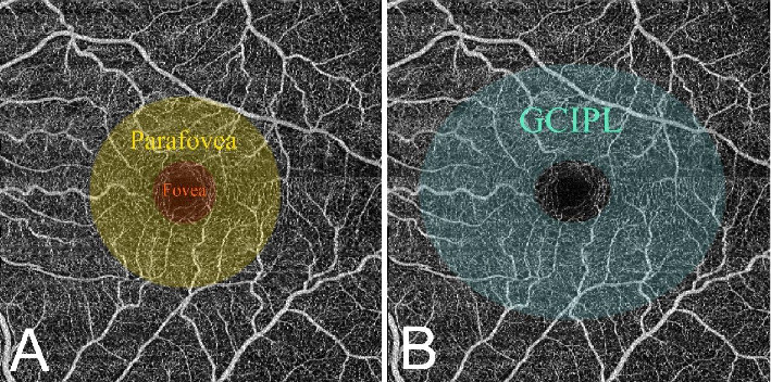 Structural and Vascular Features of Macula Related to the Recurrence of Macular Edema in Central Retinal Vein Occlusion After Anti-VEGF Therapy.