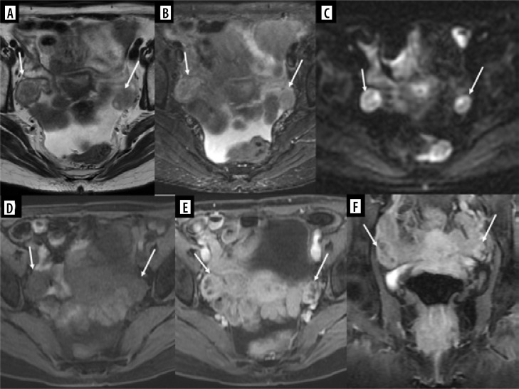 The reproductive system and breast metastases - a narrative review and case series of metastases from soft tissue and bone sarcomas in girls.