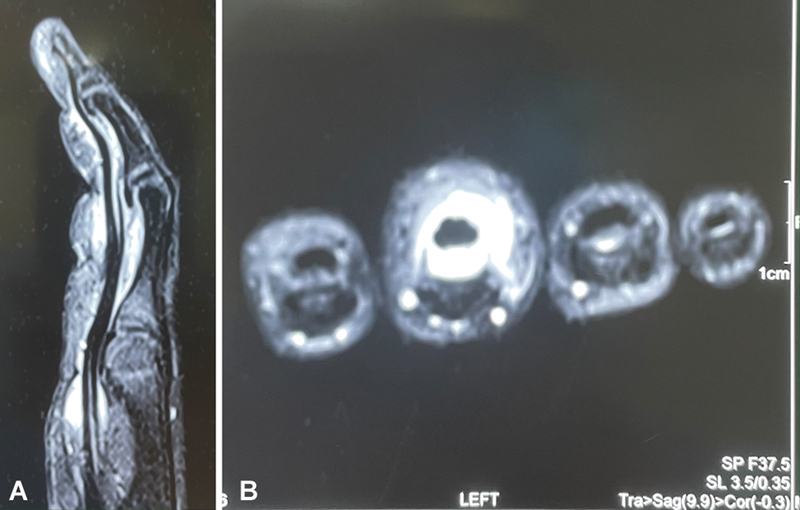 Flexor Tendon Tenosynovitis in a Child Following Missed Thorn Prick Injury: A Case Report.