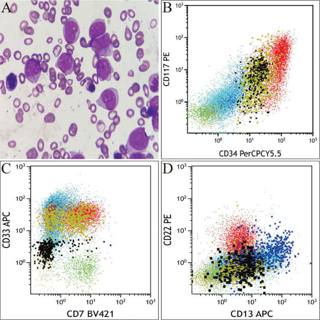 Duplication of the Long Arm of Chromosome 3 Leads to <i>MECOM</i> Rearrangement in Acute Myeloid Leukemia