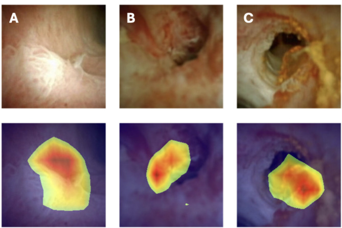 Artificial intelligence for automatic diagnosis and pleomorphic morphological characterization of malignant biliary strictures using digital cholangioscopy.
