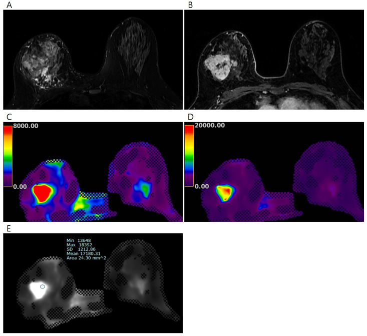 Magnetic Resonance Elastography of Invasive Breast Cancer: Evaluating Prognostic Factors and Treatment Response.