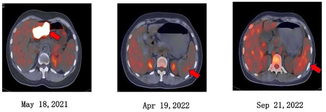 Next-generation sequencing of circulating tumor DNA in cerebrospinal fluid for detecting gene mutations in central nervous system lymphoma patients.