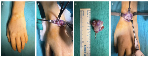 Comparative Outcomes of Open Surgical Excision for Dorsal and Volar Wrist Ganglion Cysts: A Minimum 2-Year Follow-Up Study.