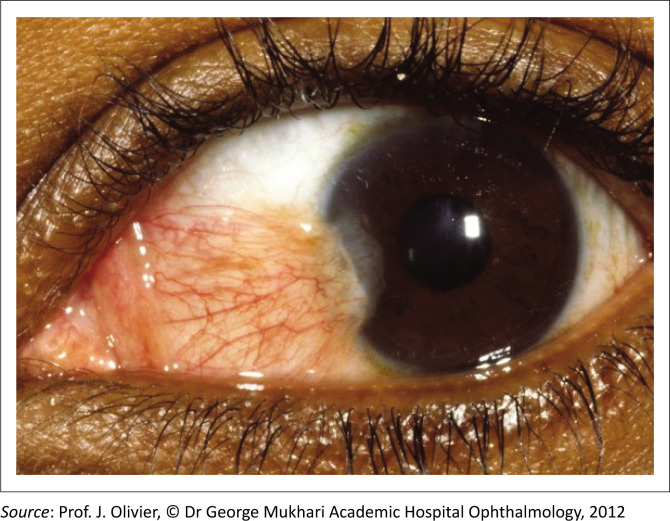 The critical role of primary care clinicians in the early detection of ocular surface squamous neoplasia.