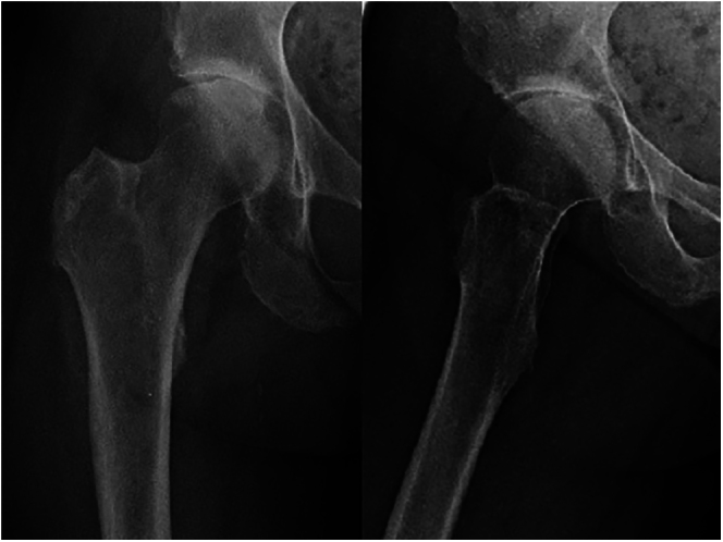 Ochronotic arthropathy: skeletal manifestations and orthopaedic treatment.
