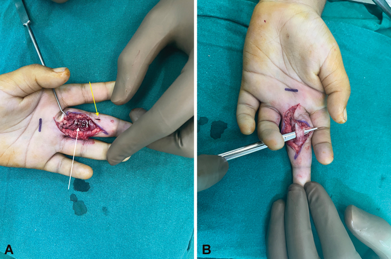 Flexor Tendon Tenosynovitis in a Child Following Missed Thorn Prick Injury: A Case Report.