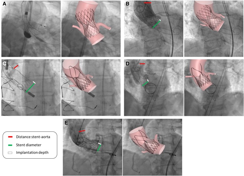The impact of bicuspid valve morphology on the selection of transcatheter aortic valve implantation devices: an <i>in silico</i> study.