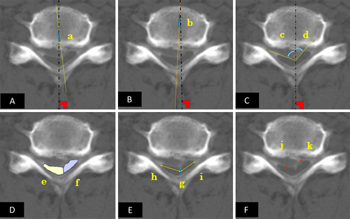 Clinical and Imaging Characteristics of Patients with Cervical Compressive Myelopathy Presenting with Unilateral Motor Deficits.