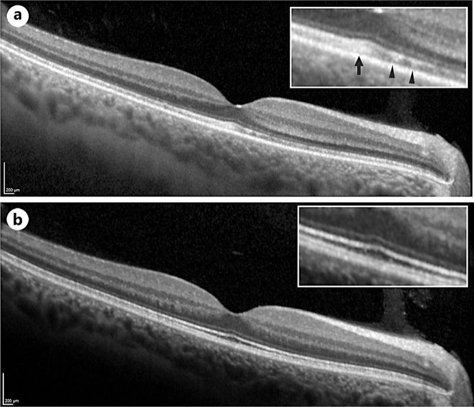 Choroidal Thickening and Outer Retinal Alterations in Vitamin A Deficiency: A Case Report.