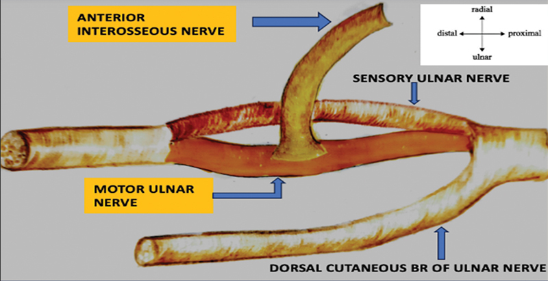 Augmentation of the Ulnar Motor Nerve Repair with Anterior Interosseous Nerve in High Ulnar Nerve Palsy: Our Clinical Experience.