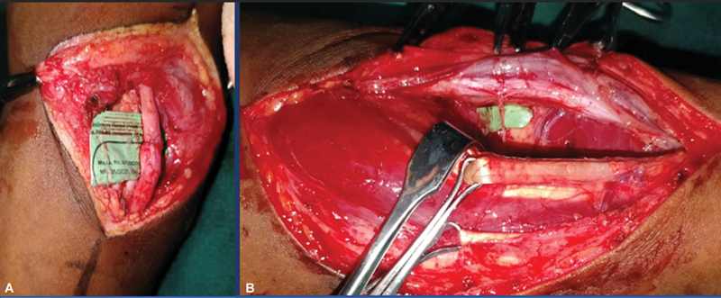 Augmentation of the Ulnar Motor Nerve Repair with Anterior Interosseous Nerve in High Ulnar Nerve Palsy: Our Clinical Experience.
