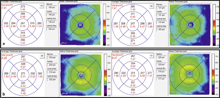 Choroidal Thickening and Outer Retinal Alterations in Vitamin A Deficiency: A Case Report.