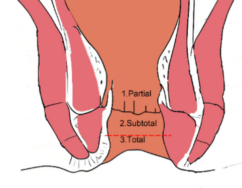 The Review of Modified Intersphincteric Resection in the Treatment of Ultra-Low Rectal Cancer.