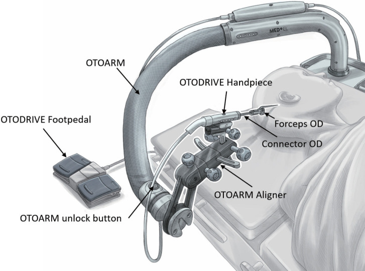 Robotic Versus Manual Electrode Insertion in Cochlear Implant Surgery: An Experimental Study.