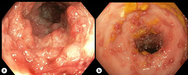 Inflammatory Bowel Disease in a Patient Returning from Colombia: Association with Dipeptidyl Peptidase 4 Inhibitor?