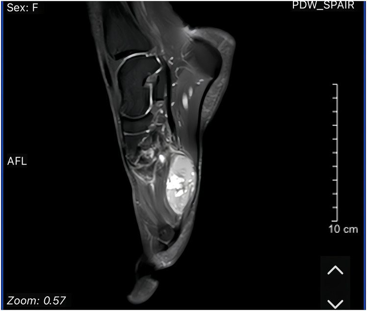 An extralingual Ectomesenchymal chondromyxoid tumor with RREB1::MRTFB fusion: a rare case report of plantar fascia involvement.