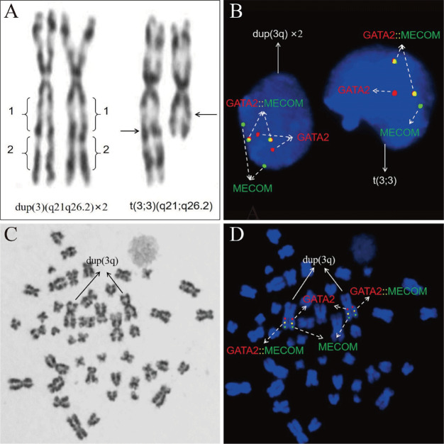 Duplication of the Long Arm of Chromosome 3 Leads to <i>MECOM</i> Rearrangement in Acute Myeloid Leukemia