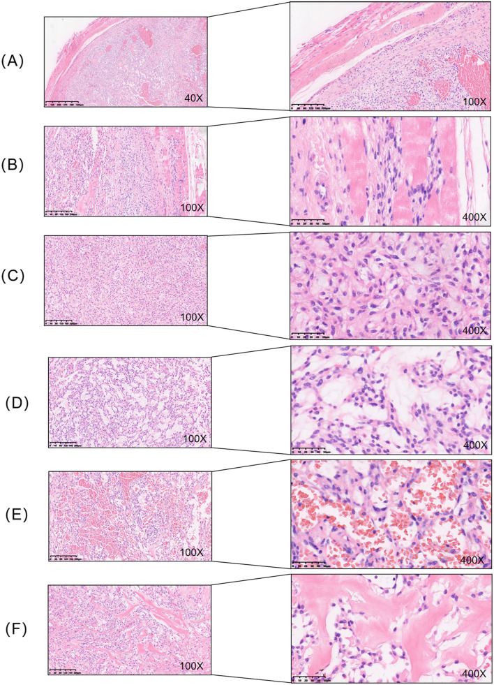 An extralingual Ectomesenchymal chondromyxoid tumor with RREB1::MRTFB fusion: a rare case report of plantar fascia involvement.