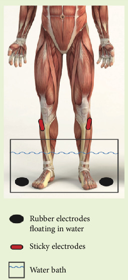 An Open-Label Comparative Study of the Impact of Two Types of Electrical Stimulation (Direct Current Neuromuscular Electrical Stimulation and Transcutaneous Electrical Stimulation) on Physical Therapy Treatment of Diabetic Peripheral Neuropathy.