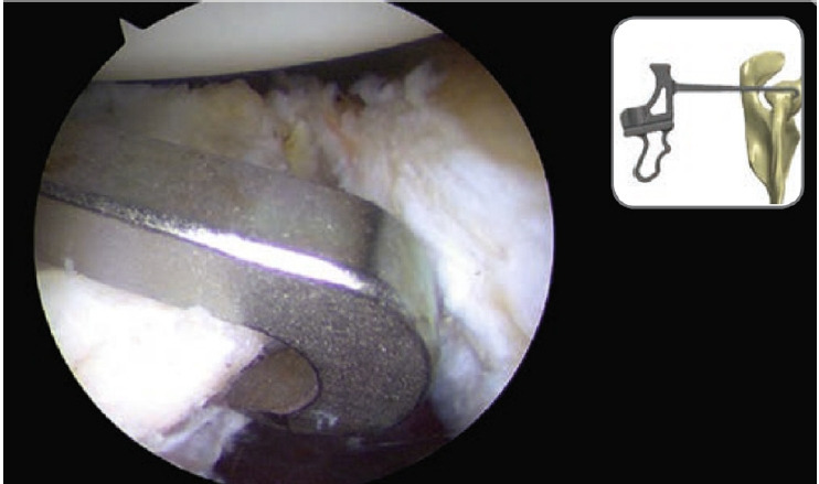 Use of posteroanterior reference guides for bone block or coracoid process transfer in anterior glenohumeral instability: a cadaveric study of the relationship to the suprascapular nerve.