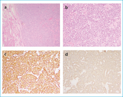 Intracardiac Glomus Tumor Obstructing the Right Ventricular Outflow Tract: A Rare Case Report.