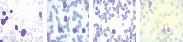 Artificial Intelligence Powered Automated and Early Diagnosis of Acute Lymphoblastic Leukemia Cancer in Histopathological Images: A Robust SqueezeNet-Enhanced Machine Learning Framework.