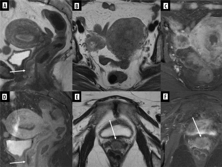 The reproductive system and breast metastases - a narrative review and case series of metastases from soft tissue and bone sarcomas in girls.