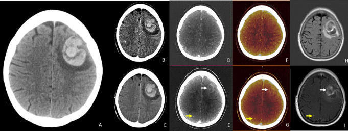 Dual-energy CT angiography in detecting underlying causes of intracerebral hemorrhage: an observational cohort study.