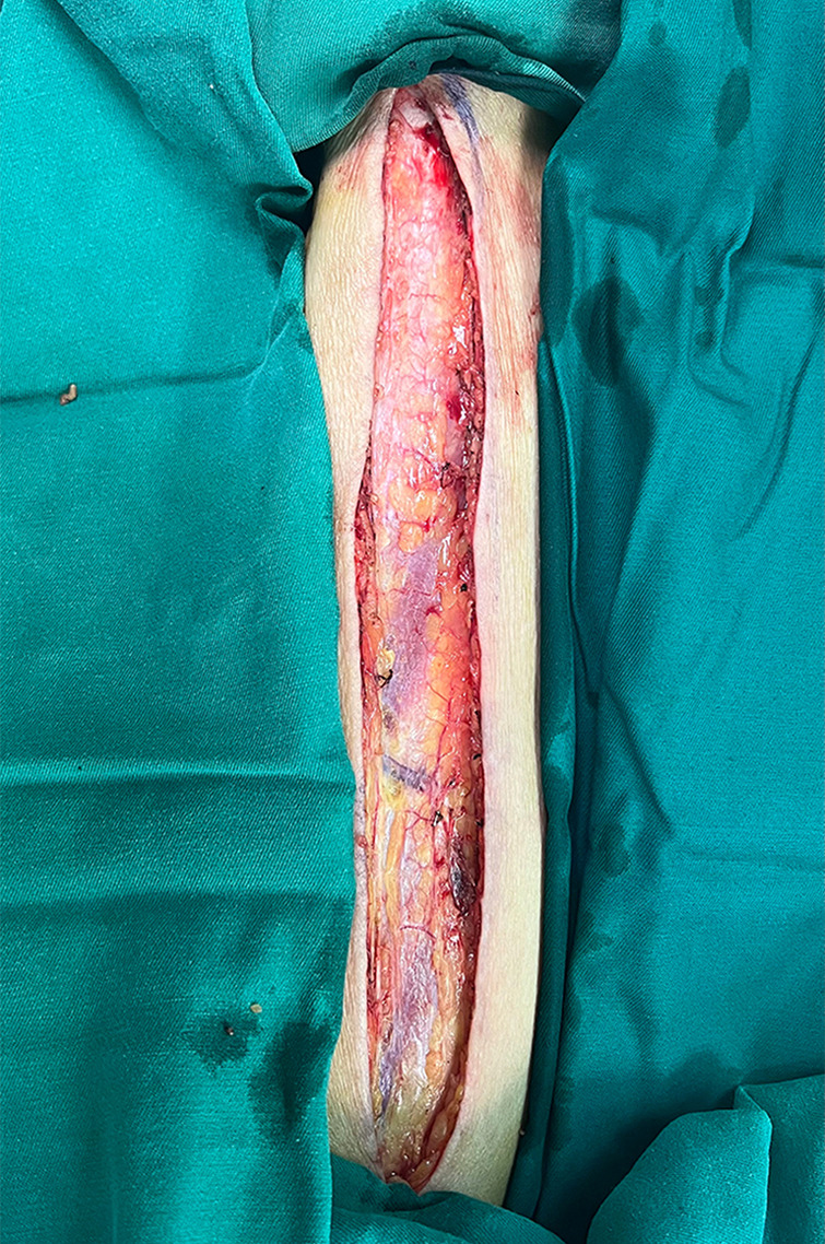 One-year patency rates of saphenous vein grafts harvested using the no-touch technique in off-pump coronary artery bypass grafting.