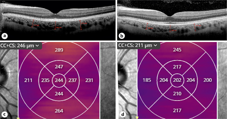 Choroidal Thickening and Outer Retinal Alterations in Vitamin A Deficiency: A Case Report.