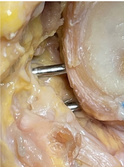 Use of posteroanterior reference guides for bone block or coracoid process transfer in anterior glenohumeral instability: a cadaveric study of the relationship to the suprascapular nerve.